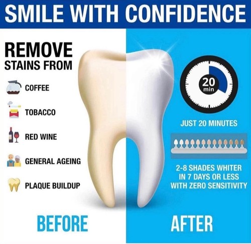 Smilekit teeth whitening - teeth,